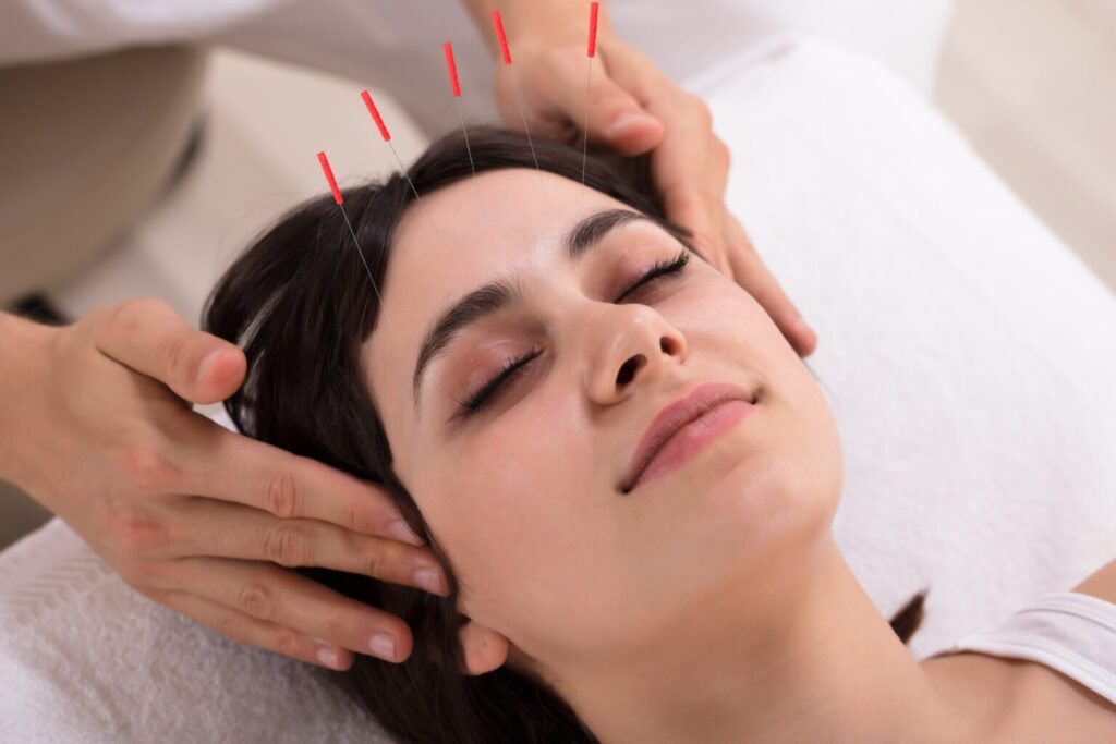 Acupuncture; Traditional Chinese Medicine