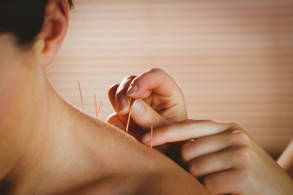 Traditional Acupuncture Methods